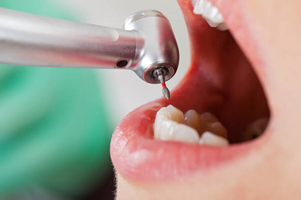 Best Emergency Root Canal Treatment in Richfield, OH